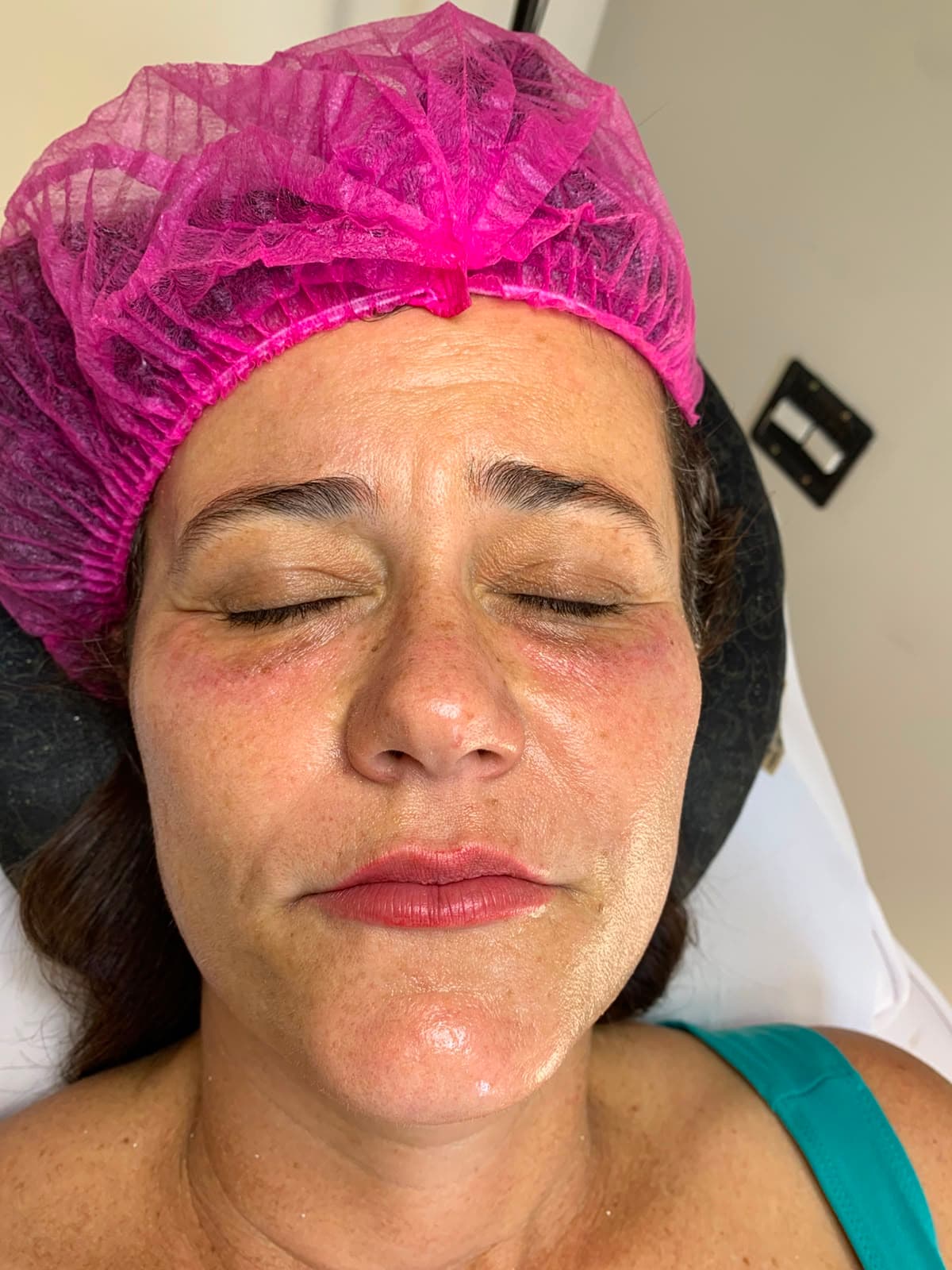 Depois: Laser transdérmico de microvasos: 3 sessões • a partir de R$ 597/sessão